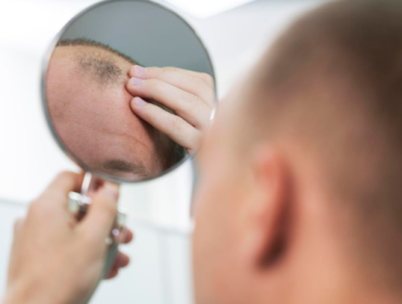 Ilustrasi rambut rontok.(Foto: FREEPIK)