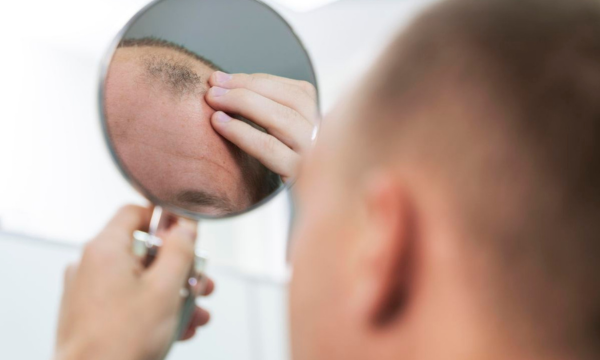 Ilustrasi rambut rontok.(Foto: FREEPIK)