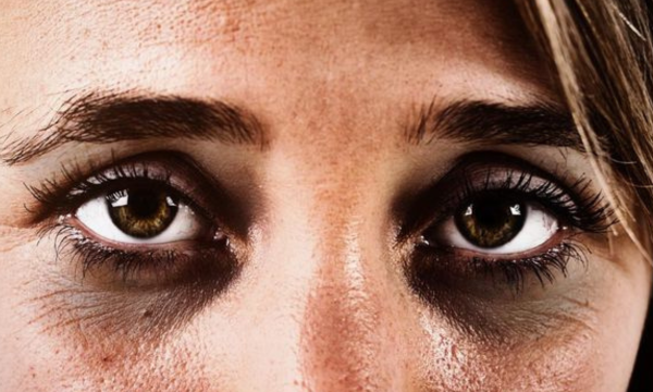 Ilustrasi. Mata melotot bisa jadi tanda mengalami gejala penyakit ini. (Foto: 
iStockphoto/RapidEye)
